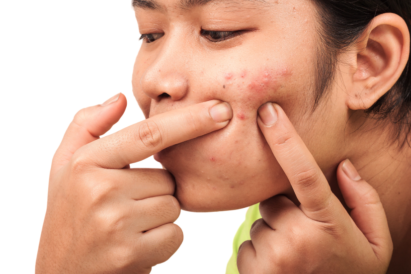 Acne extraction